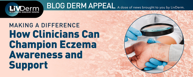 eczema