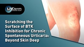 Scratching the Surface of BTK Inhibition for Chronic Spontaneous Urticaria Beyond Skin Deep